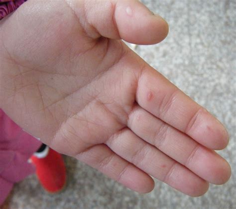 手走口病初期图片，分别有4大症状