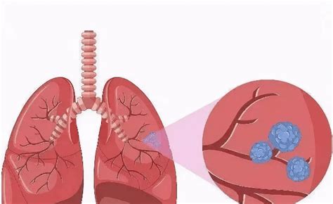 肺结节是什么意思 严重吗，指肺纤维引起肺内有结节
