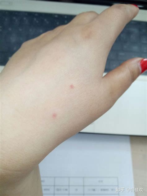 蚊子刚咬完身体带血吗，蚊子咬的小红点多久会消失