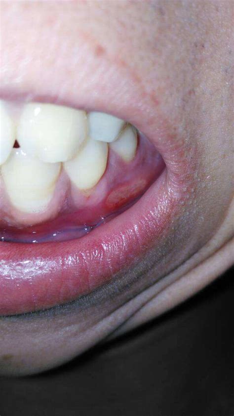 牙龈癌早期症状有哪些，牙龈癌刚开始的图片