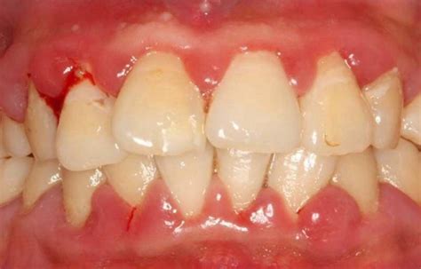 牙龈炎的症状有哪些图片，牙周炎和牙龈炎的区别